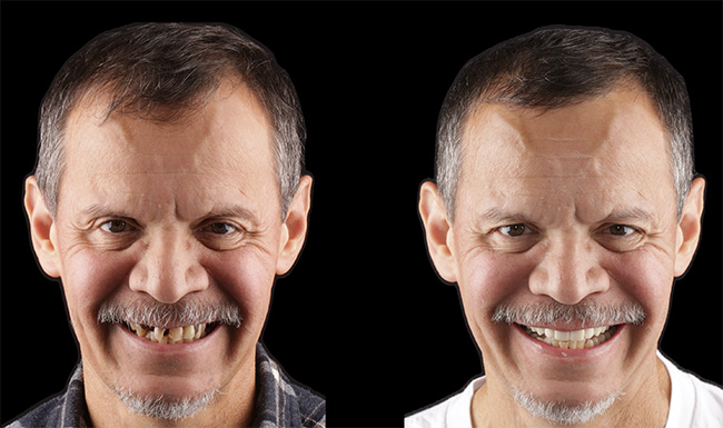 St. John Smiles Family Dentistry | Veneers, All-on-4 reg  and Dentures