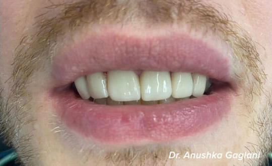 Family Dentist in St. John IN