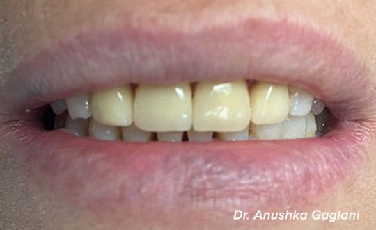 Dental Implants Dentist in St. John IN