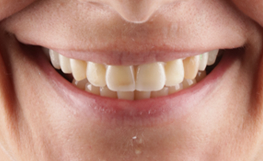 St. John Smiles Family Dentistry | Botox reg , Digital Scanners and All-on-4 reg 