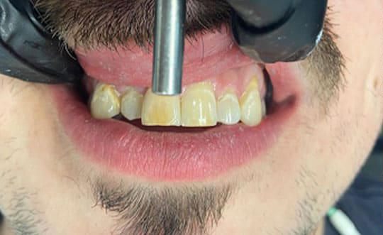 Family Dentist in St. John IN