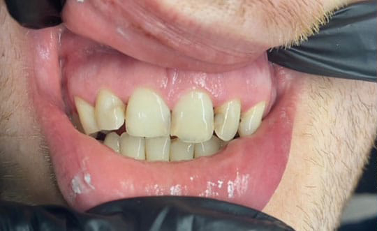 Dental Implants Dentist in St. John IN