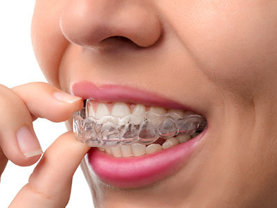 St. John Smiles Family Dentistry | Invisalign reg , Dentures and Root Canals