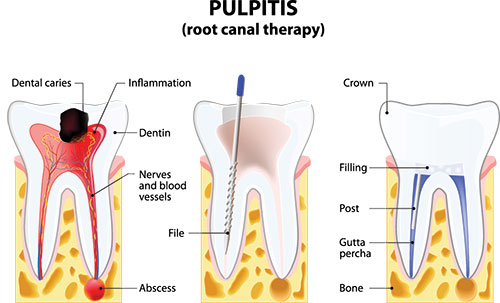 St. John Smiles Family Dentistry | Implant Restorations, Ceramic Crowns and Periodontal Treatment